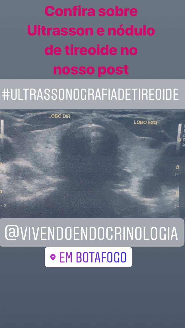 Ultrassom e Nódulos de Tireoide